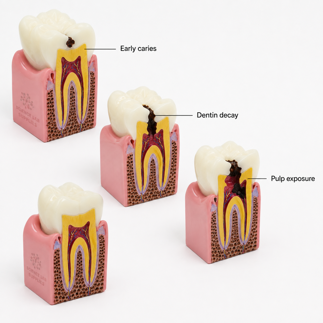 Dental Caries Model