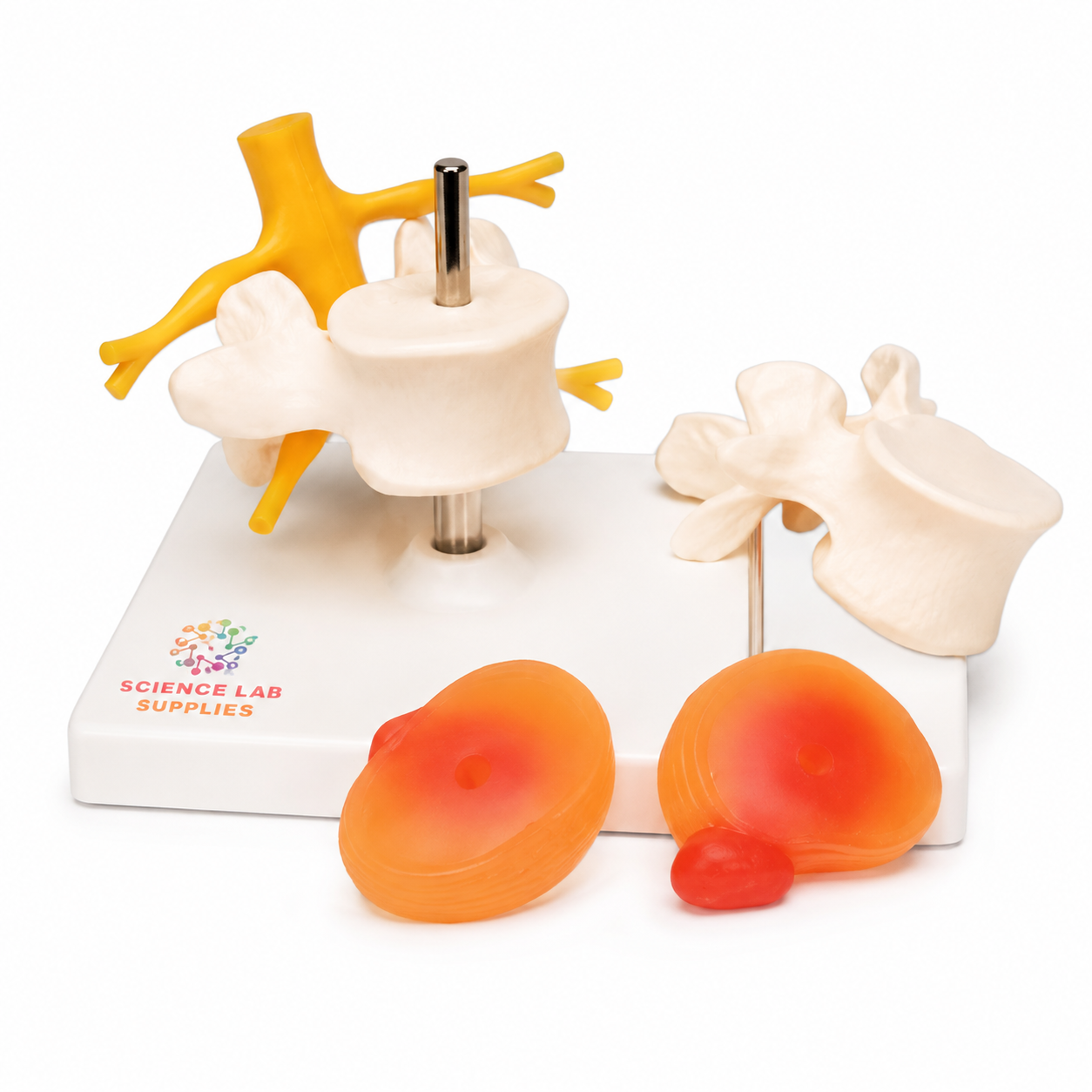 2 Lumbar Vertebrae with Hernia And Prolapsed Intervertebral Disc Model