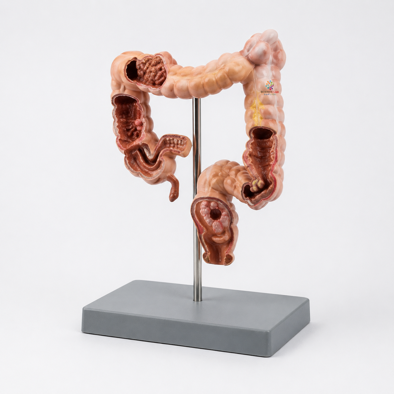 Pathological Model of The Rectum